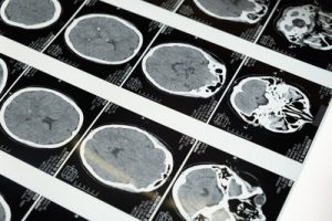 When Can You Claim Compensation for a Brain Injury in White Plains?