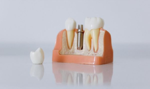 Dental Implants – What to Know Before You Get Them